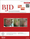 British Journal of Dermatology - Publikationen in Fachzeitschriften von Facharzt Dr. Kiermeir 